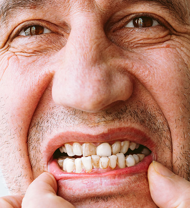 Broken Teeth Treatment Berwick