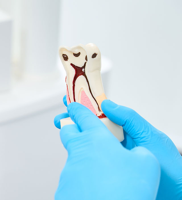 Tooth Decay Treatment Berwick