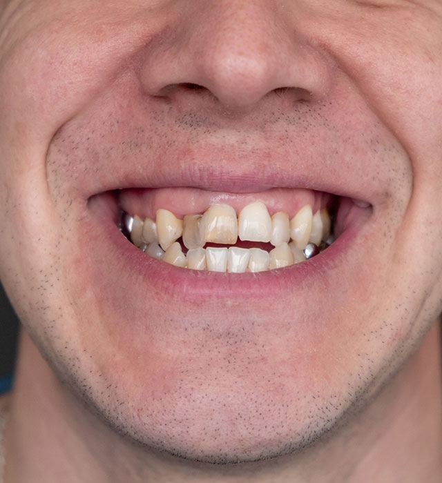 Crooked Teeth Treatment Berwick