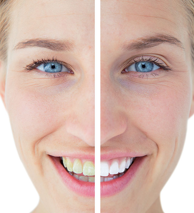 teeth whitening before and after