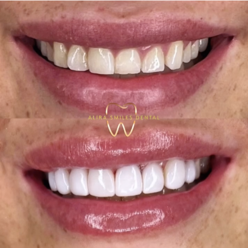 Veneers – Are They the Secret to Your Dream Smile?